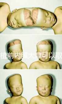 移植前內(nèi)膜太厚可以取卵早知道，疼痛因人而異