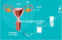 單角子宮試管成功率高嗎？送你5招降低胚胎著床的難度