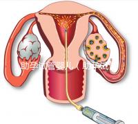 助孕試管嬰兒（助孕試管嬰兒保險(xiǎn)）