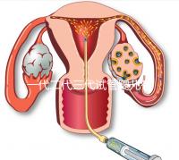 一代二代三代試管嬰兒有什么區別？