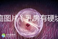 乳癌圖片（乳房有硬塊的位置圖片）