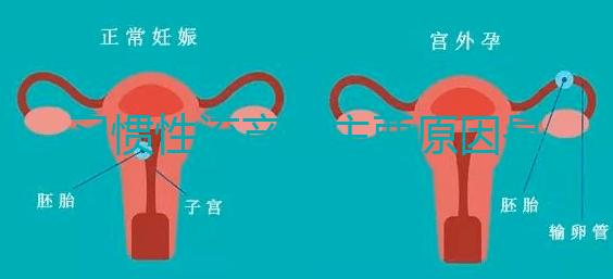 習(xí)慣性流產(chǎn)的主要原因是什么？