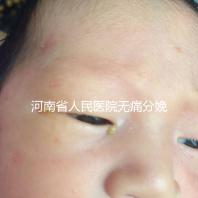 河南省人民醫院無痛分娩多少錢戳，收費標準60s看懂不踩坑