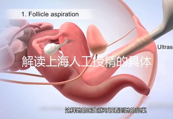 解讀上海人工授精的具體過程，會不會痛看醫生怎么說？